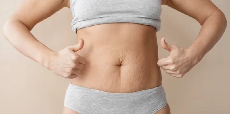 stretch mark microneedling